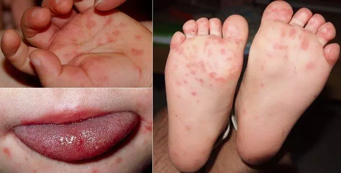 Tay chân miệng là bệnh truyền nhiễm thường gặp ở trẻ nhỏ
